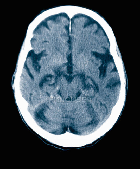 Снимок крупным планом рентгеновского снимка пожилого мужчины с болезнью Альцгеймера — стоковое фото