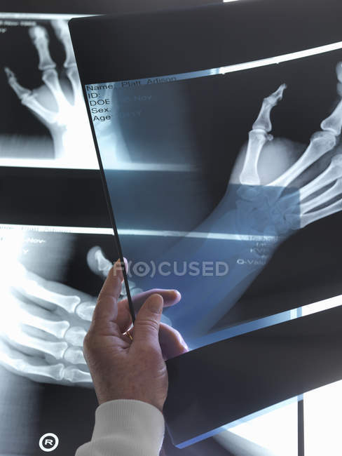 Médico mano sosteniendo rayos X de la mano en el hospital - foto de stock