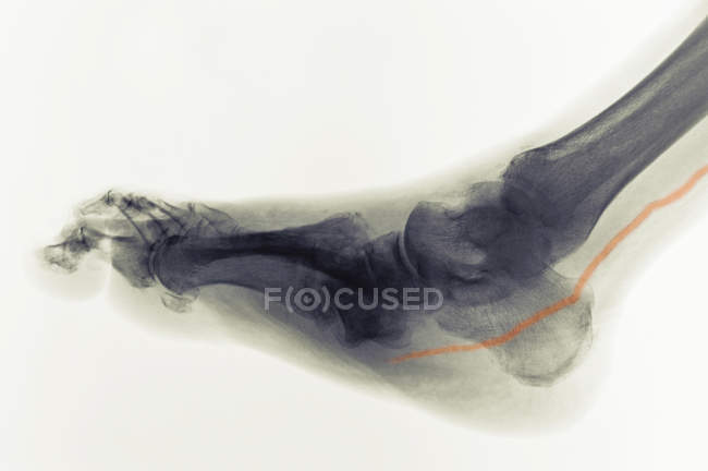 X-ray of foot of diabetic showing calcified artery — Stock Photo