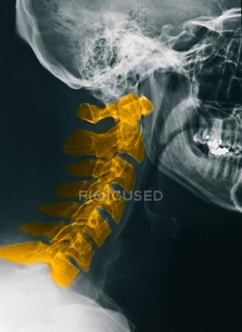 Close up view of cervical spine x-ray of mid adult man — Stock Photo