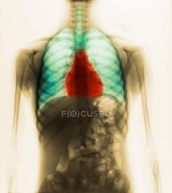 Крупним планом знімок звичайного рентгенівського знімка грудей маленької дівчинки — стокове фото