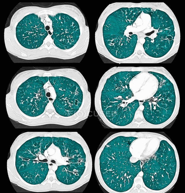 Nahaufnahme eines axialen CT-Scans der Brust zystischer Fibrosiszyste — Stockfoto