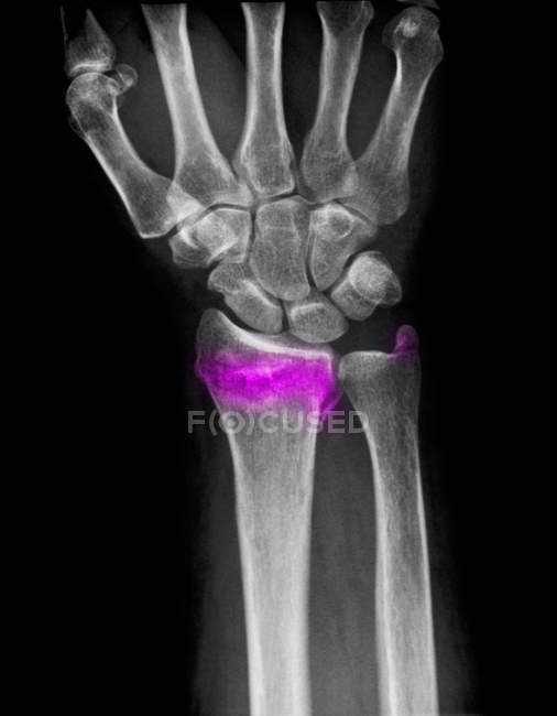 Closeup shot of wrist x-ray of comminuted fracture of radius — Stock Photo