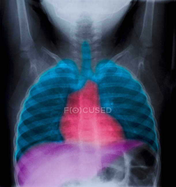 Cliché rapproché de radiographie pulmonaire normale d'une fillette de deux ans — Photo de stock