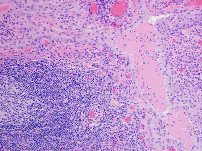 Scanning electron micrograph of rheumatoid arthritis of joint showing pannus — Stock Photo