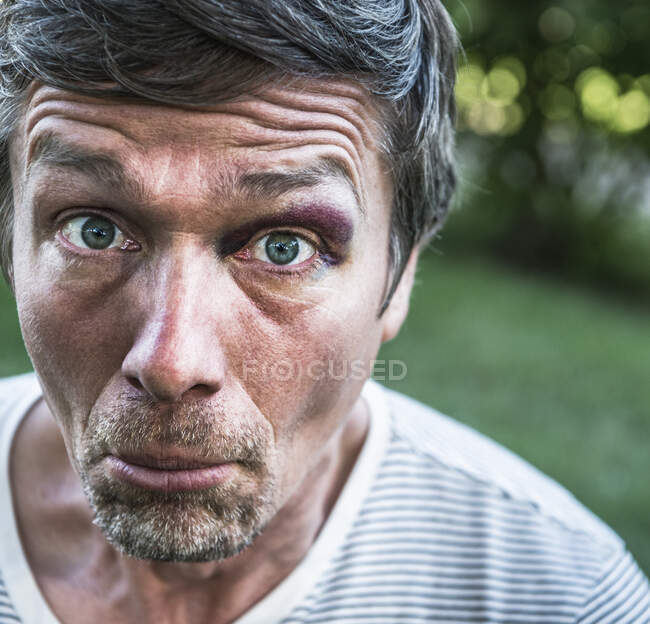 Retrato de homem com olho preto olhando para a câmera puxando rosto — Fotografia de Stock