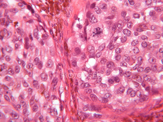 Microscope view of malignant melanoma — Stock Photo