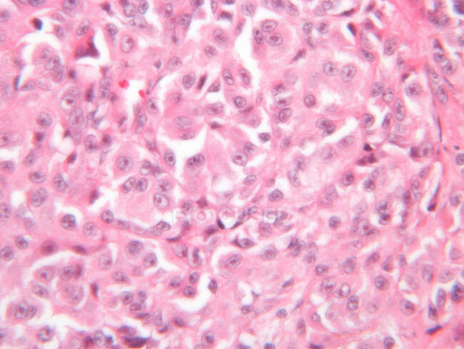 Vista del microscopio del melanoma maligno - foto de stock