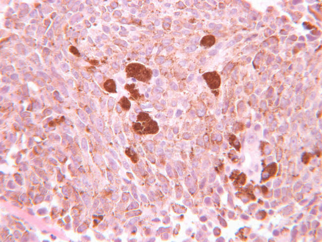 Vista del microscopio del melanoma maligno - foto de stock
