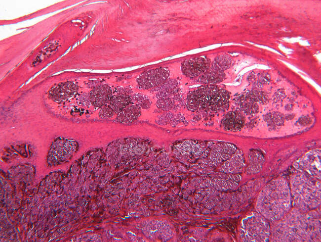 Vue au microscope du mélanome malin — Photo de stock