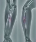 Röntgenbild des Arms einer 20-jährigen Patientin mit gebrochenem Radius (Unterarmknochen)). — Stockfoto