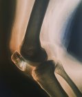 Röntgenbild einer gebrochenen Patella — Stockfoto