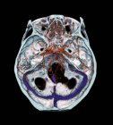 Tomografía computarizada (TC) 3D de arterias normales en el cerebro de un niño de 35 años . - foto de stock