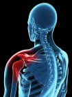 Shoulder joint pain and discomfort — Stock Photo