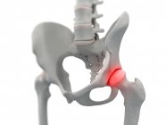 Enfoque de inflamación localizado en la articulación de cadera - foto de stock