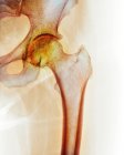 Arthritis of the hip joint — Stock Photo
