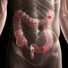 Patologia del cancro intestinale — Foto stock
