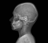 Звичайна дитяча голова. Рентген голови 13-річного . — стокове фото
