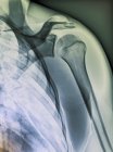 Структурная анатомия нормального плеча — стоковое фото