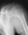Рентген сломанного плеча — стоковое фото