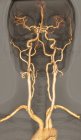 3D компьютерная томография артерий головного мозга . — стоковое фото