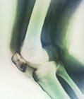Radiographie de la rotule fracturée — Photo de stock