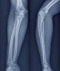 Radiografía del brazo de un paciente de 20 años con un radio fracturado (hueso inferior del brazo
). - foto de stock