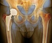 Substituição total da anca, raio-X — Fotografia de Stock