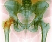 Chirurgie du remplacement de la hanche, radiographie — Photo de stock