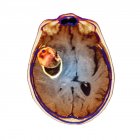Brain with aneurysm in the middle cerebral artery — Stock Photo