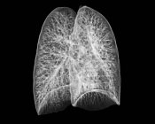 Здоровий легені 30-річного пацієнта — стокове фото