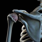 Візуальне відображення артритного плеча — стокове фото