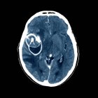Cerveau avec anévrisme dans l'artère cérébrale moyenne — Photo de stock