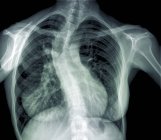 Кольоровий рентгенівський знімок сколіозу хребта — стокове фото
