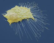 Раковые клетки остеосаркомы — стоковое фото