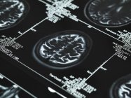 Серія сканування мозку МРТ — стокове фото