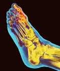 Deformación degenerativa del pie, rayos X - foto de stock