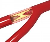 Arteria ristretta che causa aterosclerosi — Foto stock