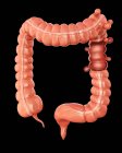 Gros intestin présentant une diverticulite — Photo de stock