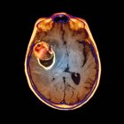 Cerebro con aneurisma en la arteria cerebral media - foto de stock