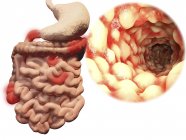 Enfermedad de Crohn, ilustración por ordenador . - foto de stock