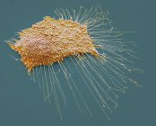 Раковые клетки остеосаркомы — стоковое фото