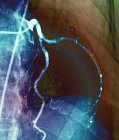 Angiogramma colorato (radiografia dei vasi sanguigni) delle arterie coronarie di un paziente di 52 anni. L'arteria a destra ha avuto uno stent collocato in esso per trattare un blocco . — Foto stock