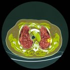 Кольорові комп'ютерної томографії (Коннектикут) сканування розділ через груди 76-річна пацієнта чоловічої статі з злоякісні (ракової) пухлини (яскравий, праворуч) у бронхів. — стокове фото
