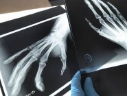 Image radiographique des os de la main — Photo de stock