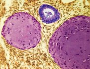 Рак яичка или тератома — стоковое фото