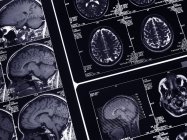 Поперечний розріз людського мозку — стокове фото