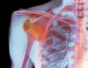 Radiografía del hombro dislocado - foto de stock