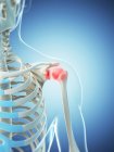 Focus of inflammation localized in shoulder joint — Stock Photo