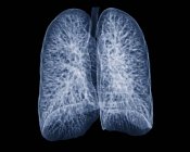 Healthy lungs of a 30 year old patient — Stock Photo